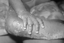 Monkeypox