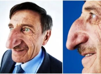 Muž s největším nosem na světě