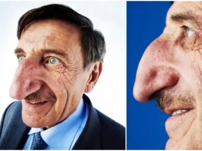 Muž s největším nosem na světě